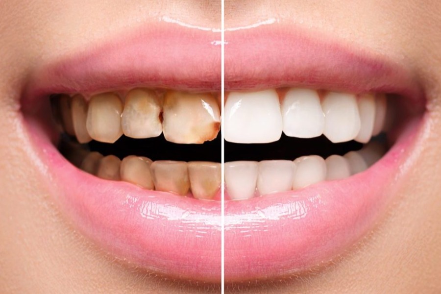 کامپوزیت دندان در قم