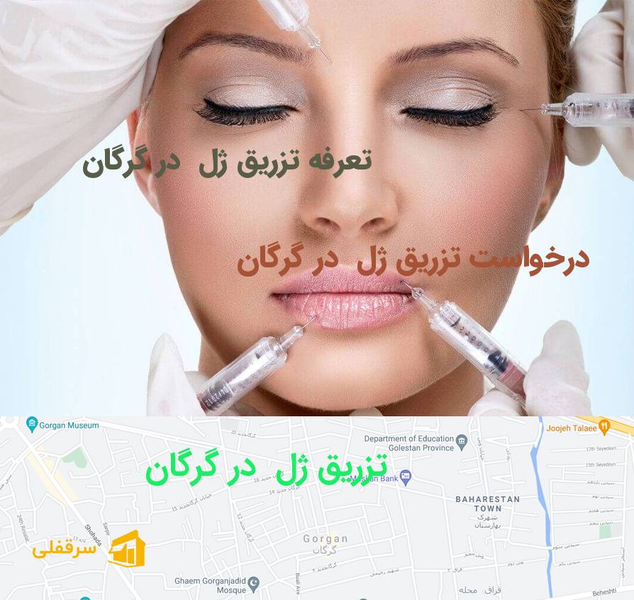 تزریق ژل در گرگان