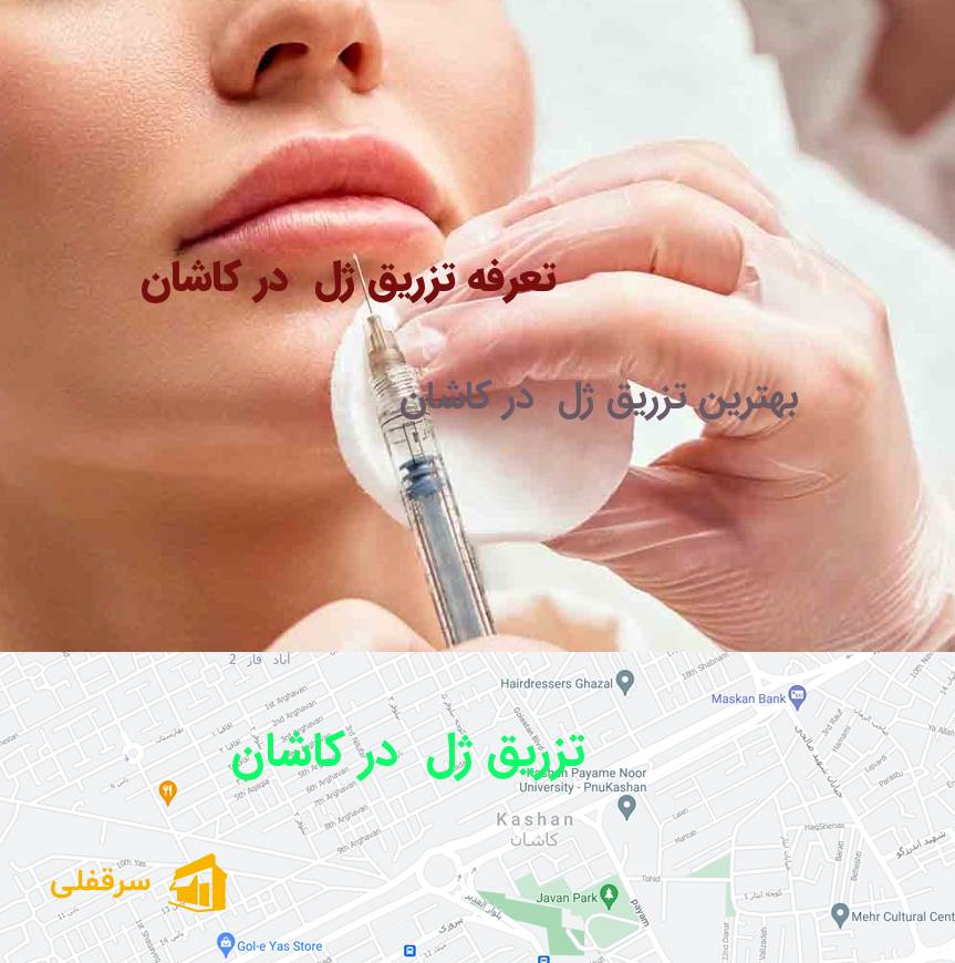 تزریق ژل در کاشان