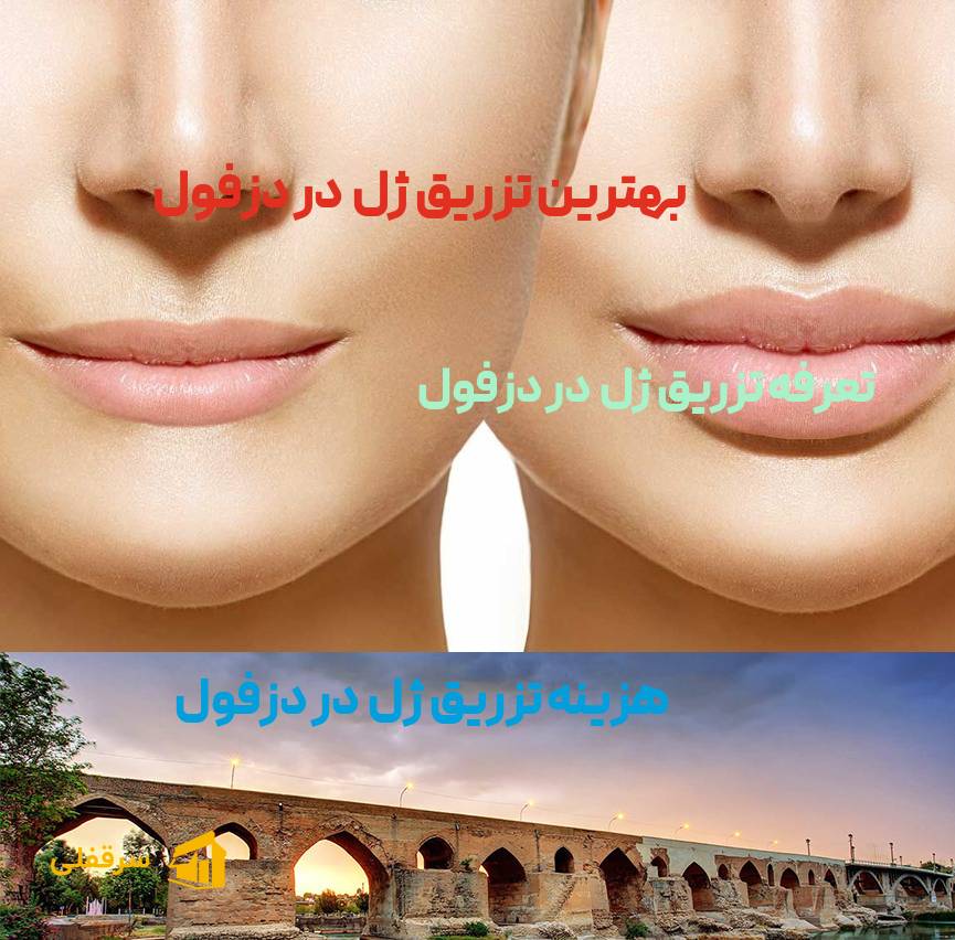 تزریق ژل در دزفول