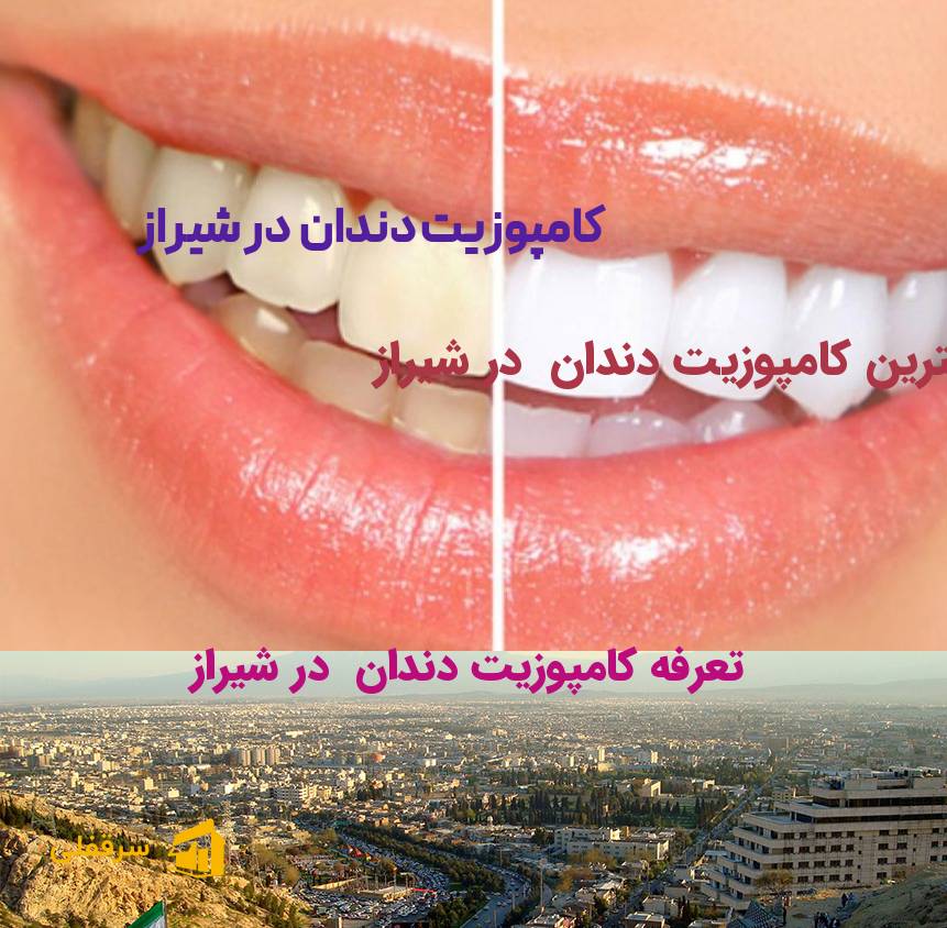 کامپوزیت دندان در شیراز