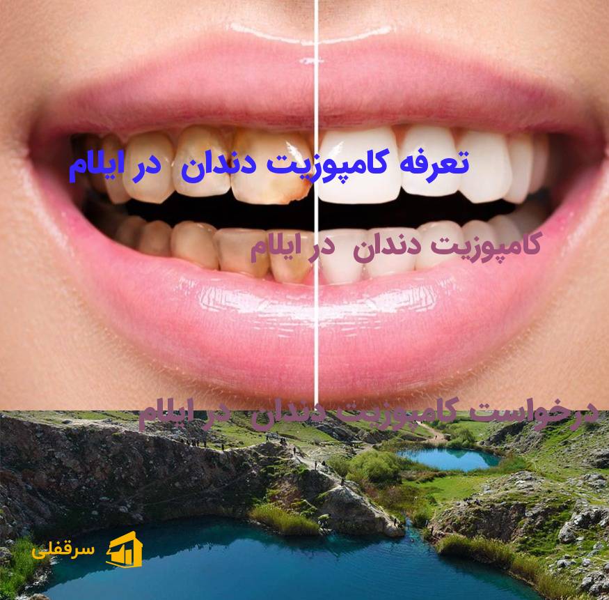 کامپوزیت دندان در ایلام