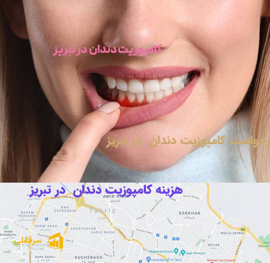 کامپوزیت دندان در تبریز