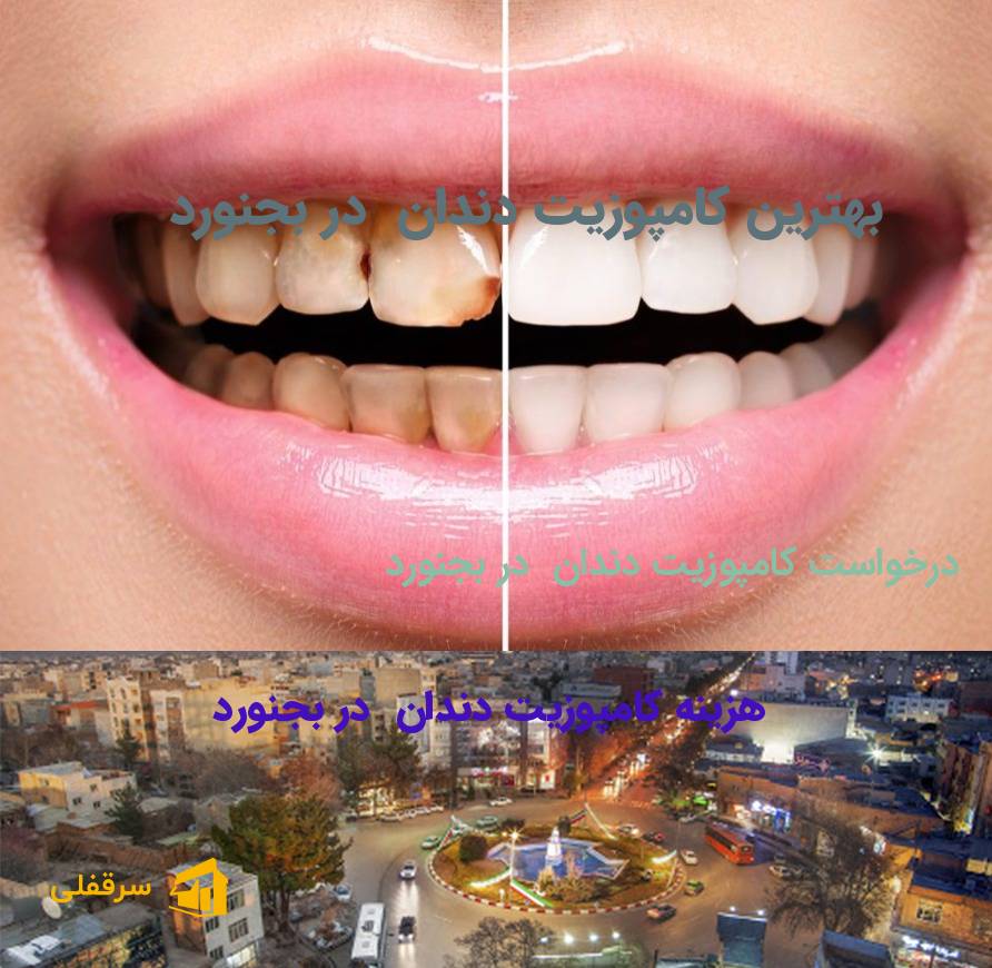 کامپوزیت دندان در بجنورد