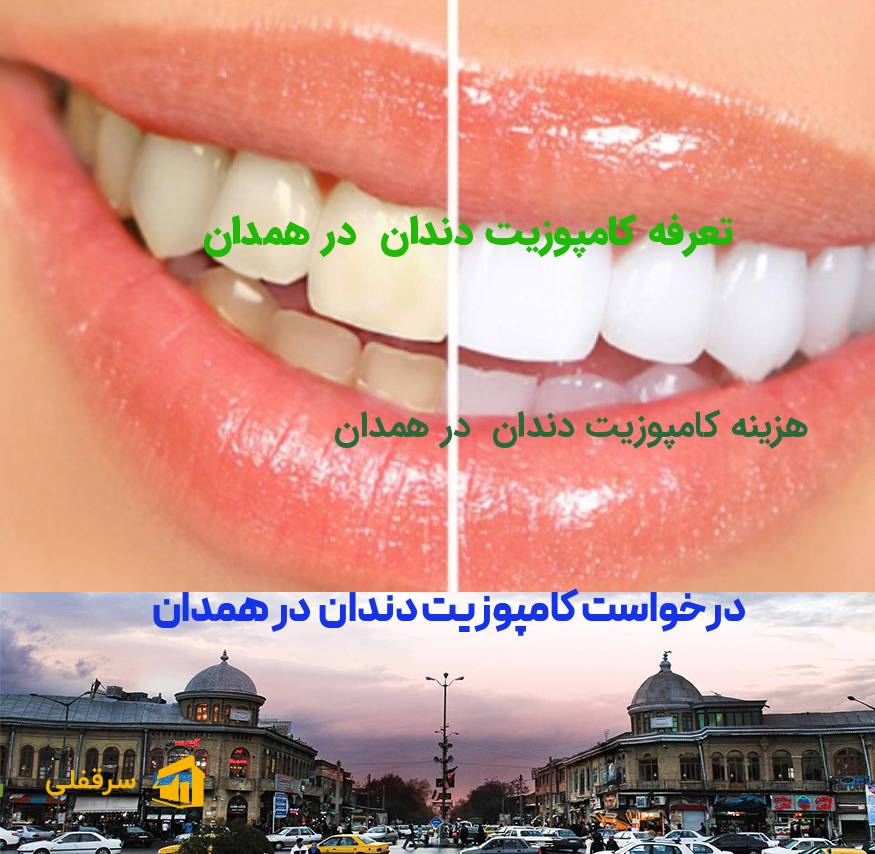 کامپوزیت دندان در همدان