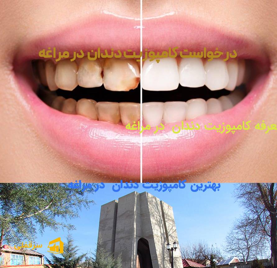 کامپوزیت دندان در مراغه