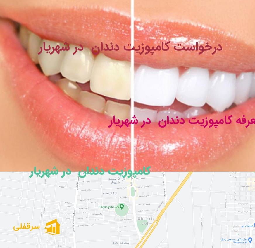 کامپوزیت دندان در شهریار