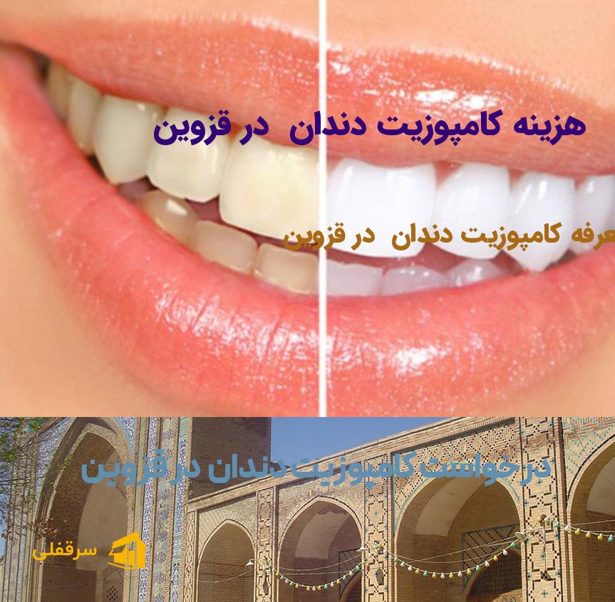 کامپوزیت دندان در قزوین
