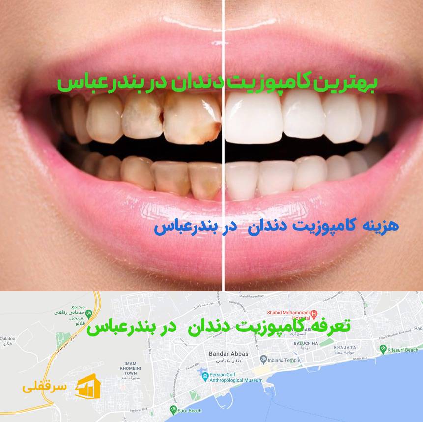 کامپوزیت دندان در بندرعباس