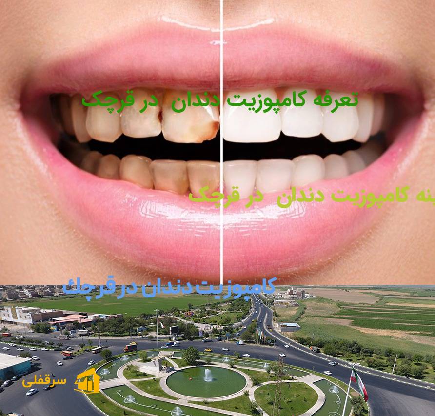 کامپوزیت دندان در قرچک