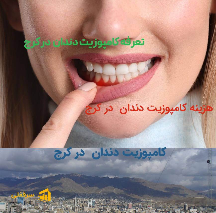 کامپوزیت دندان در کرج