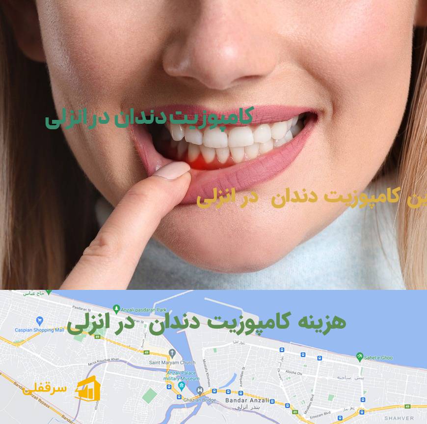 کامپوزیت دندان در انزلی
