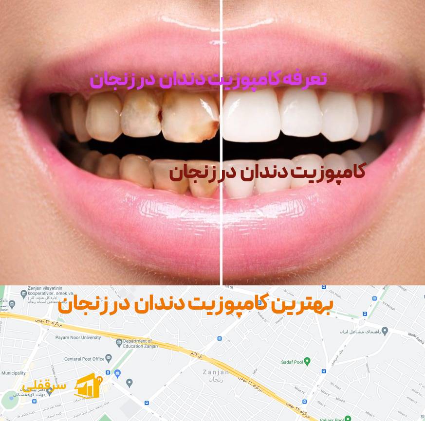 کامپوزیت دندان در زنجان